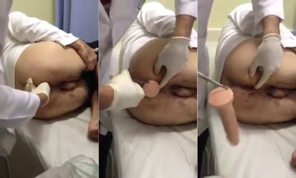 Man ends up in the ER after huge dildo he was pleasuring himself with stuck in his ass